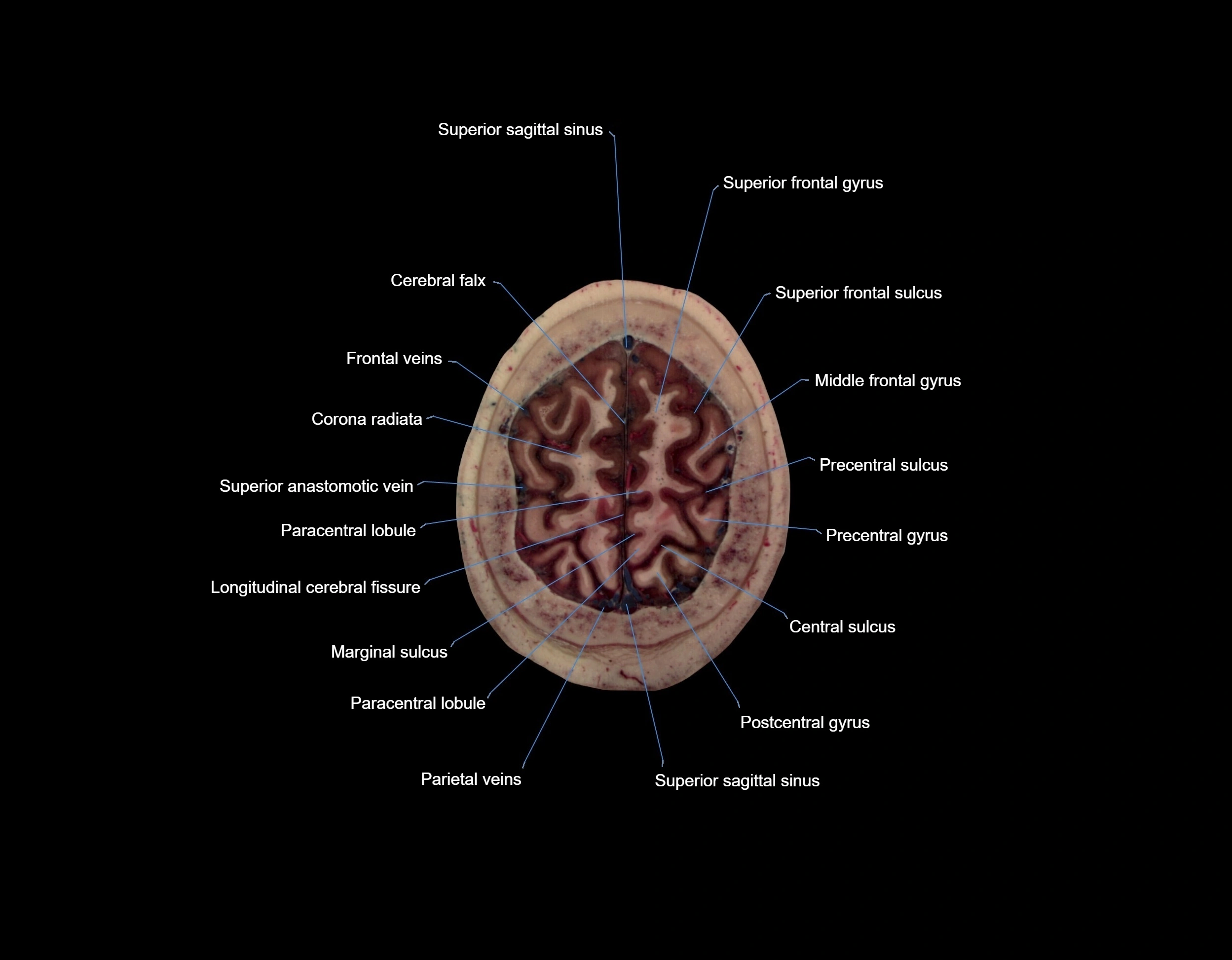 MRI Brain axial cross sectional radiology anatomy 3T image  -img-000069.webp